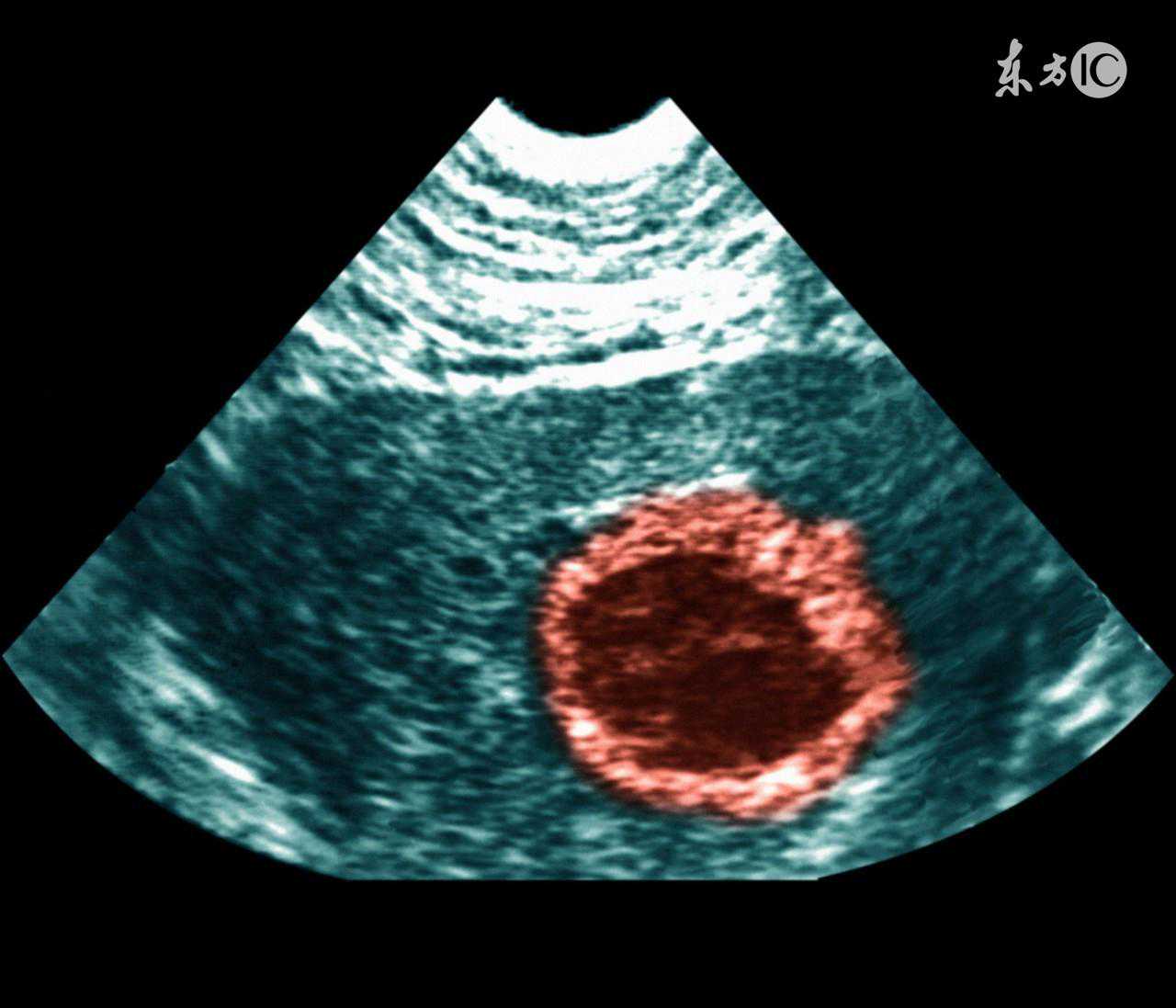 试管宝宝来之不易，试管妈妈如何预防流产？
