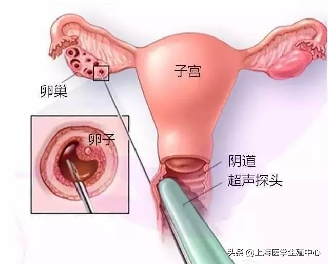 试管知识 - 穿刺取卵疼不疼，对身体有什么影响？