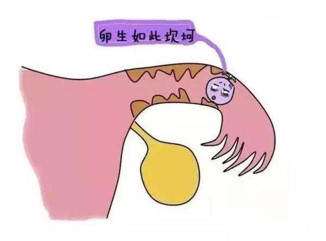 做试管婴儿也会宫外孕吗？长征医院专家这么说......