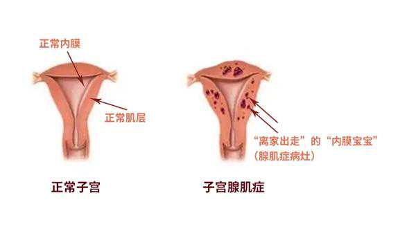 尤昭玲教授为“出走的”内膜与试管搭起“孕育之桥”