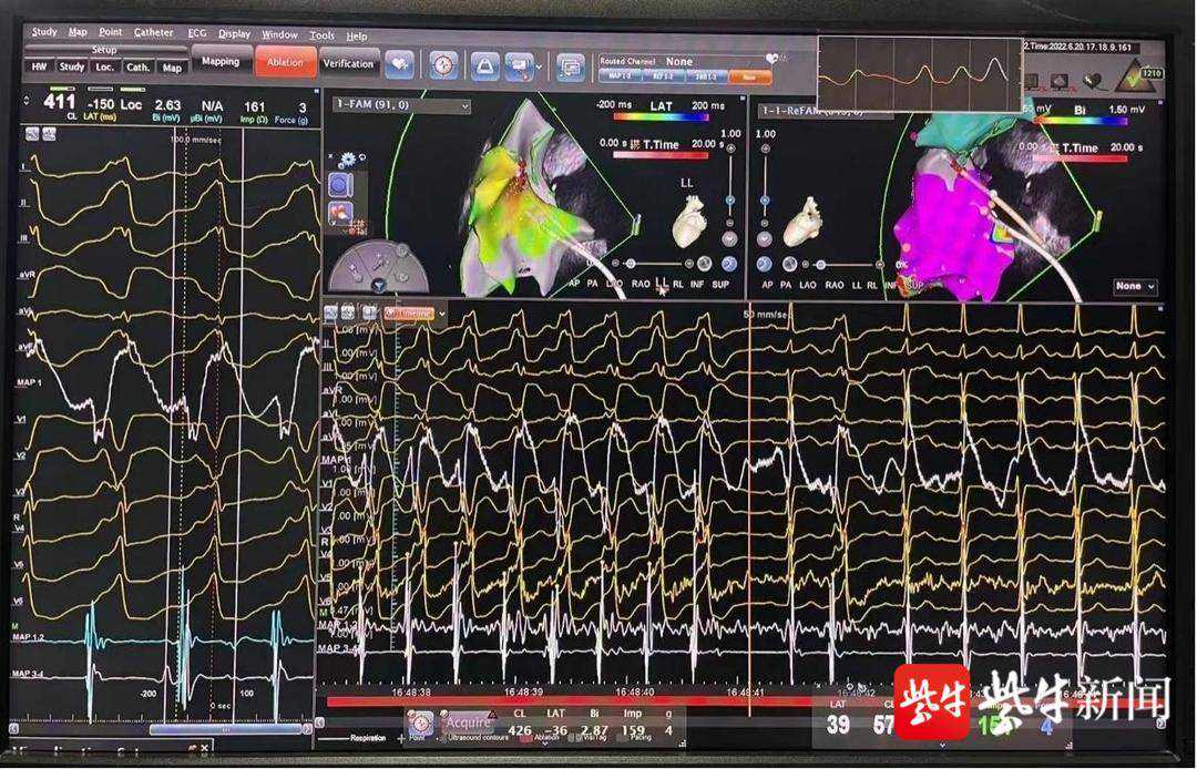怀着试管宝宝，准妈妈心电图上8万次心脏异常