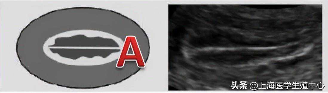 试管婴儿检查中子宫内膜的A、B、C型代表什么意思？