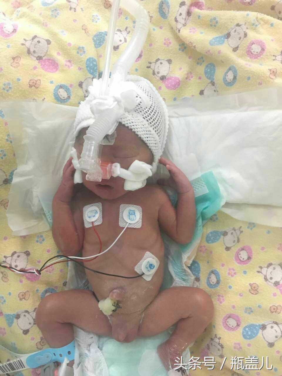 7个月试管婴儿早产！体重一共5斤！宝宝你们要坚强！