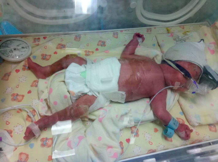 试管新生双胞胎出生两月一直和病魔抗争，谁来拯救顽强的小生命？