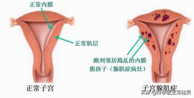备孕科普：子宫腺肌症患者越来越多，现在最好的治疗方法是什么？