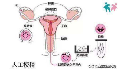 人工授精和试管婴儿并不是一回事?想要生孩子,备孕夫妻尽量早知道